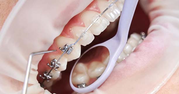 Preventive Orthodontics